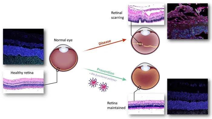A healthy retina contains organized light-sensitive layers of neurons at the back of the eye. Upon retinal scarring, it can result in retinal detachment with loss of these organized layers and visual impairment. Application of a bio-functional thermogel prevents this detachment and maintains the retina.