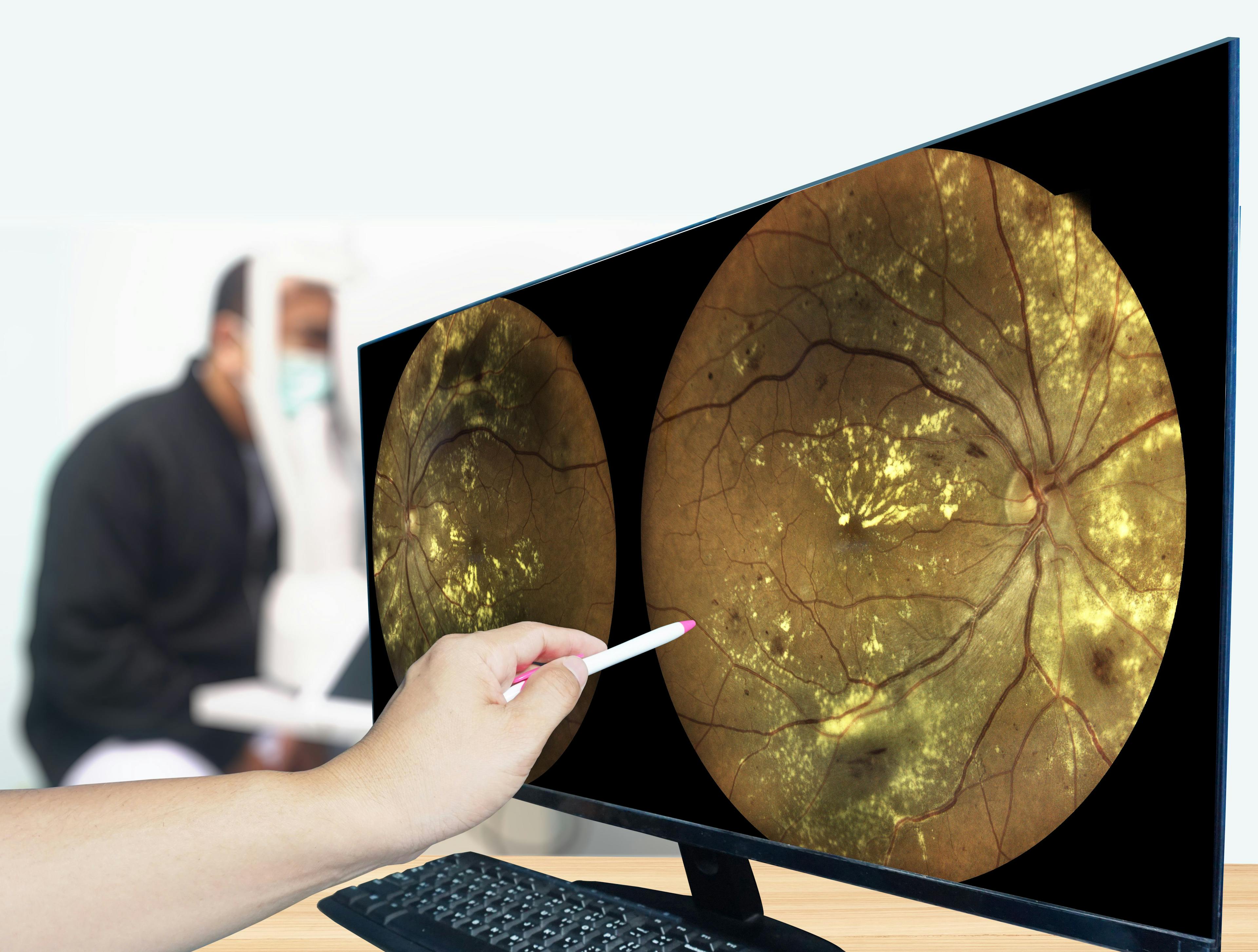 Early fundus findings of DR include microaneurysms, intraretinal hemorrhages, cotton wool spots, and exudation. (Adobe Stock image)