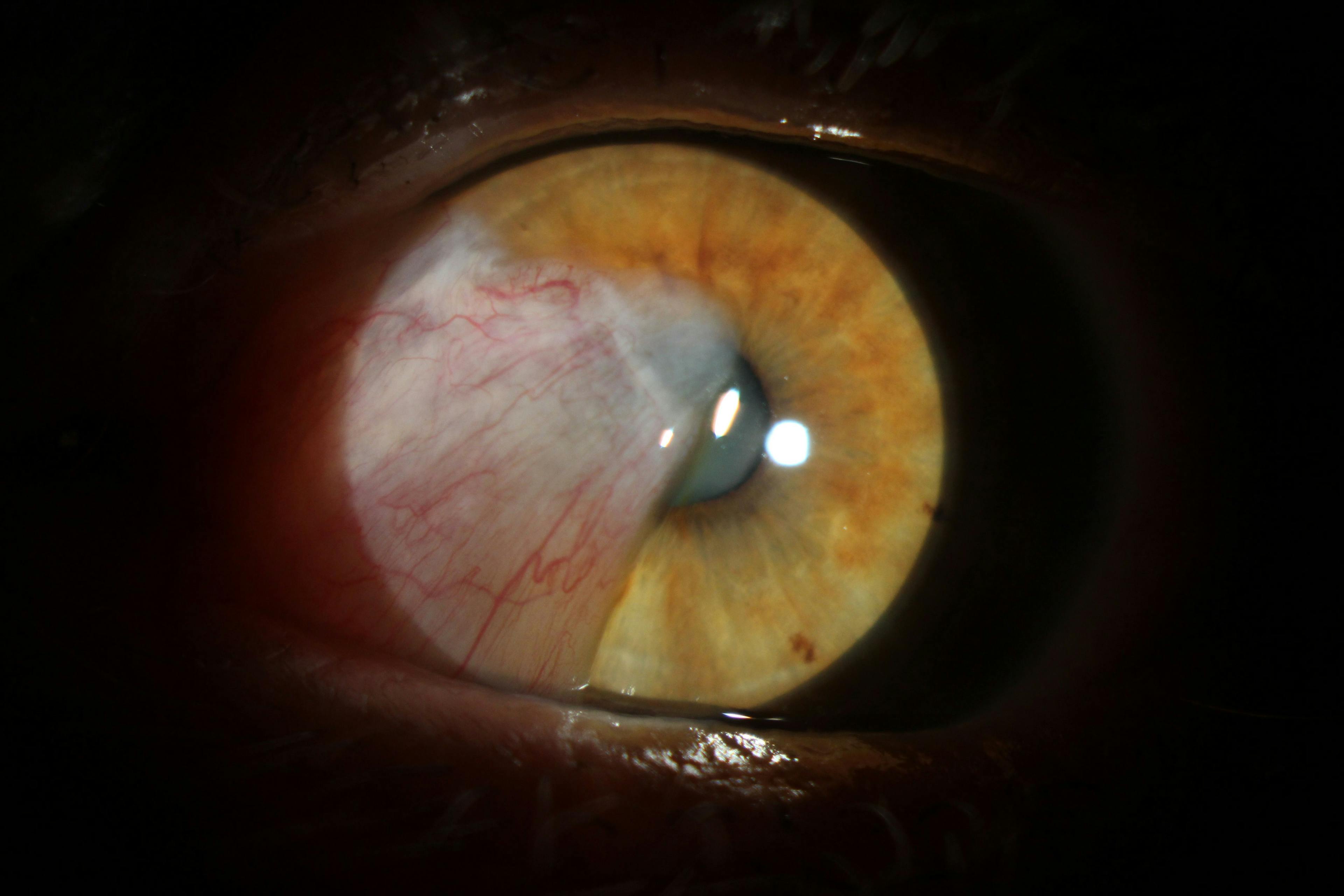 cataract and patient with DME