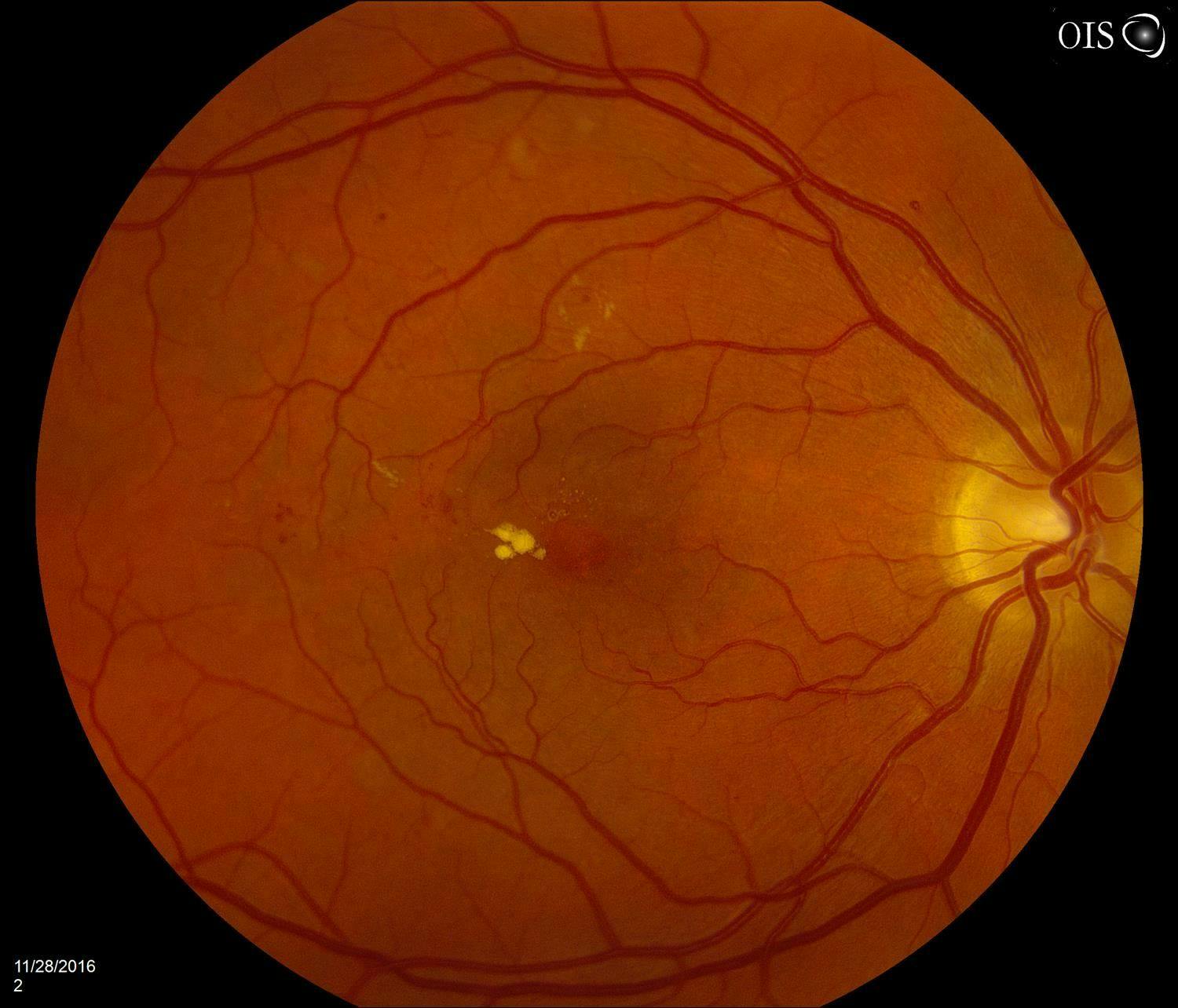 Fundus image of diabetic macular edema.