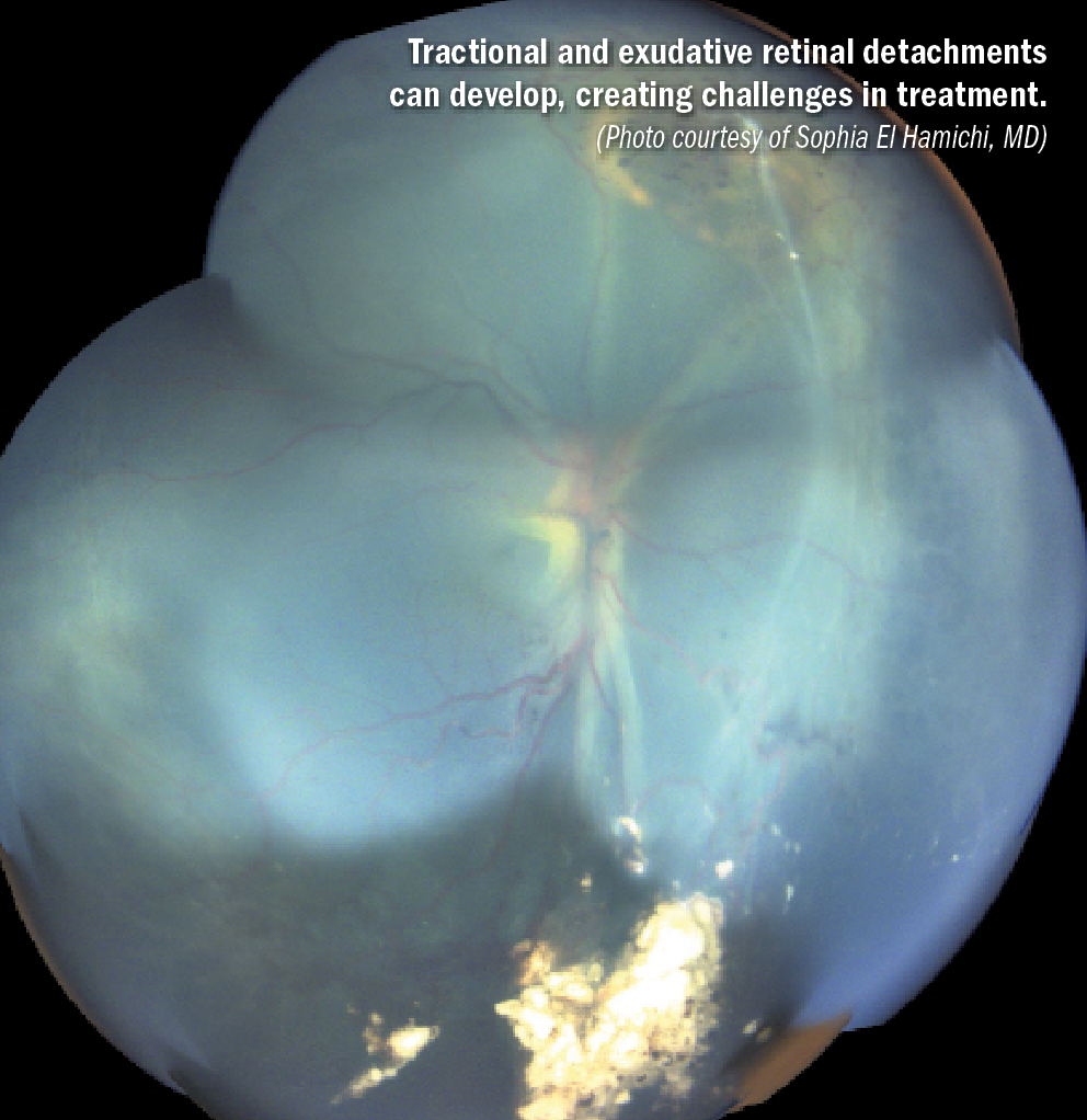 retinal detachments