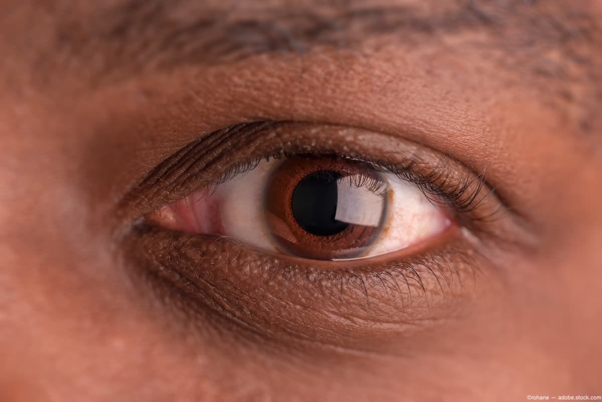 India-based Eyestem receives approval to commence human trial for Eyecyte RPE for AMD