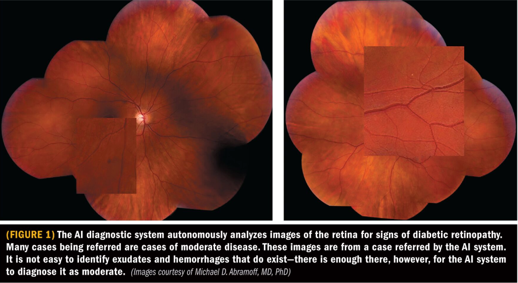 Applying AI in fundus images