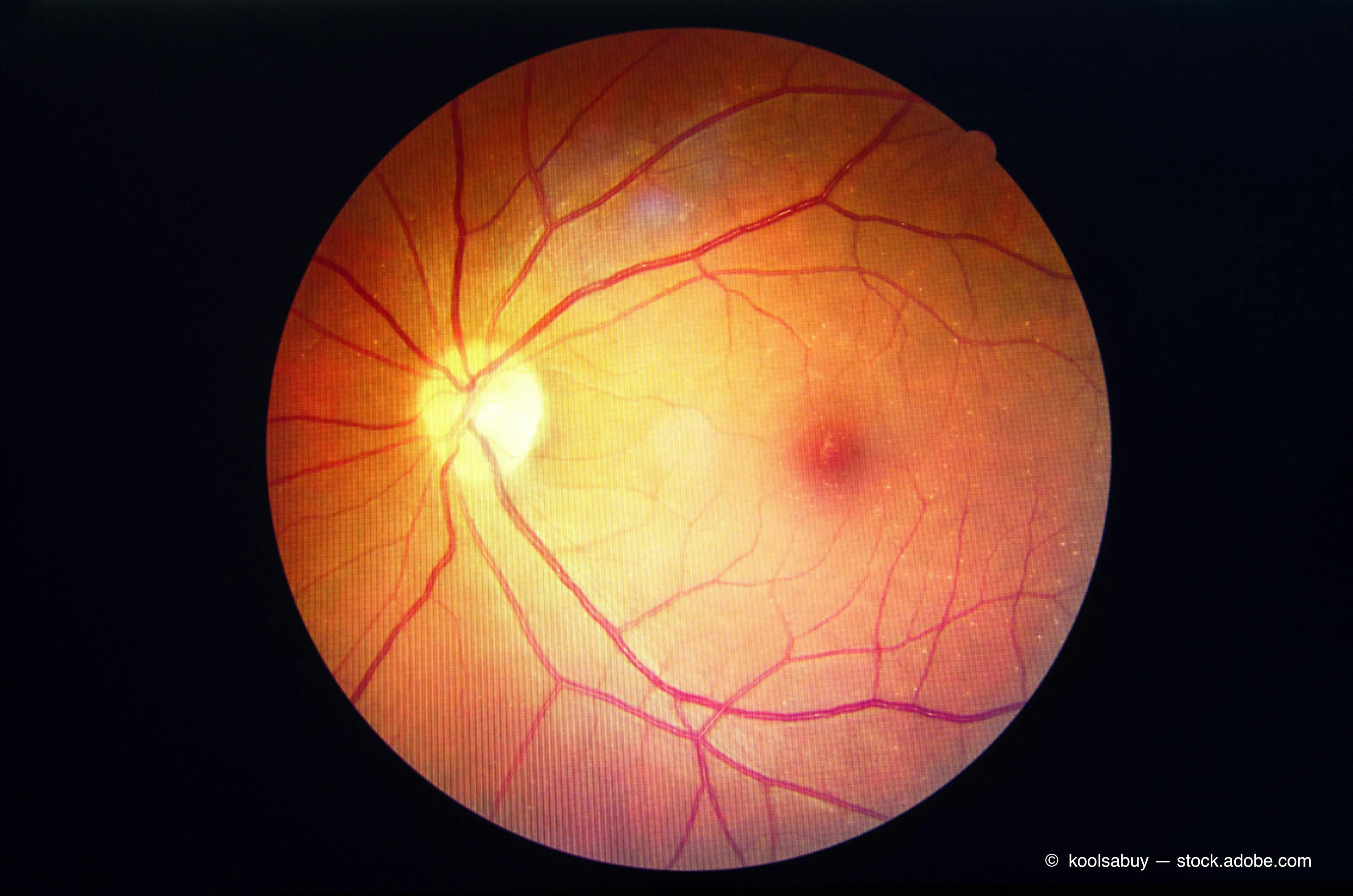 Retinal nonperfusion and leakage areas are important variables to consider when managing patients with nonproliferative diabetic retinopathy, according to PANORAMA investigators.