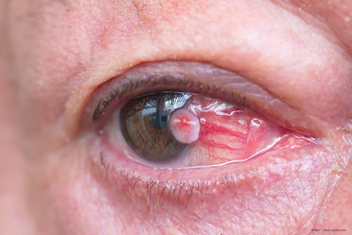 Ocular surface tumors, though rare, often prove deadly