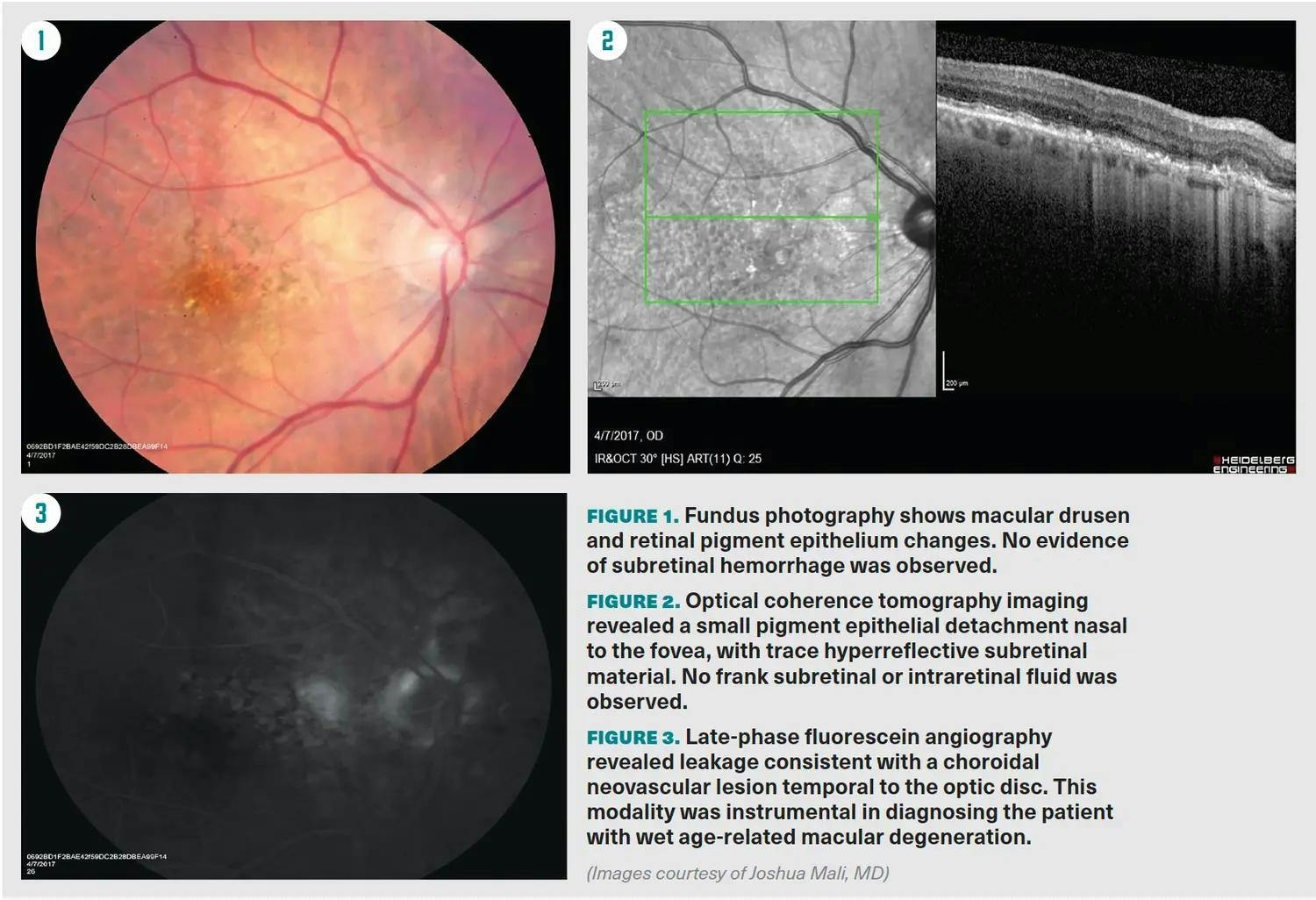 Figures 1: Fudus photography shows macular drusen and retinal pigment epithelium changes. No evidence of subretinal hemorrhage was observed. Figure 2: OCT imaging revealed a small pigment epithelial detachment nasal to the fovea, with trace hyperreflective subretinal material. No frank subretinal or intraretinal fluid was observed. Figure 3: Late-phase fluorescein angiography revealed leakage consistent with a choroidal neovascular lesion temporal to the optic disc. This modality was instrumental in diagnosing the patient with wet AMD.