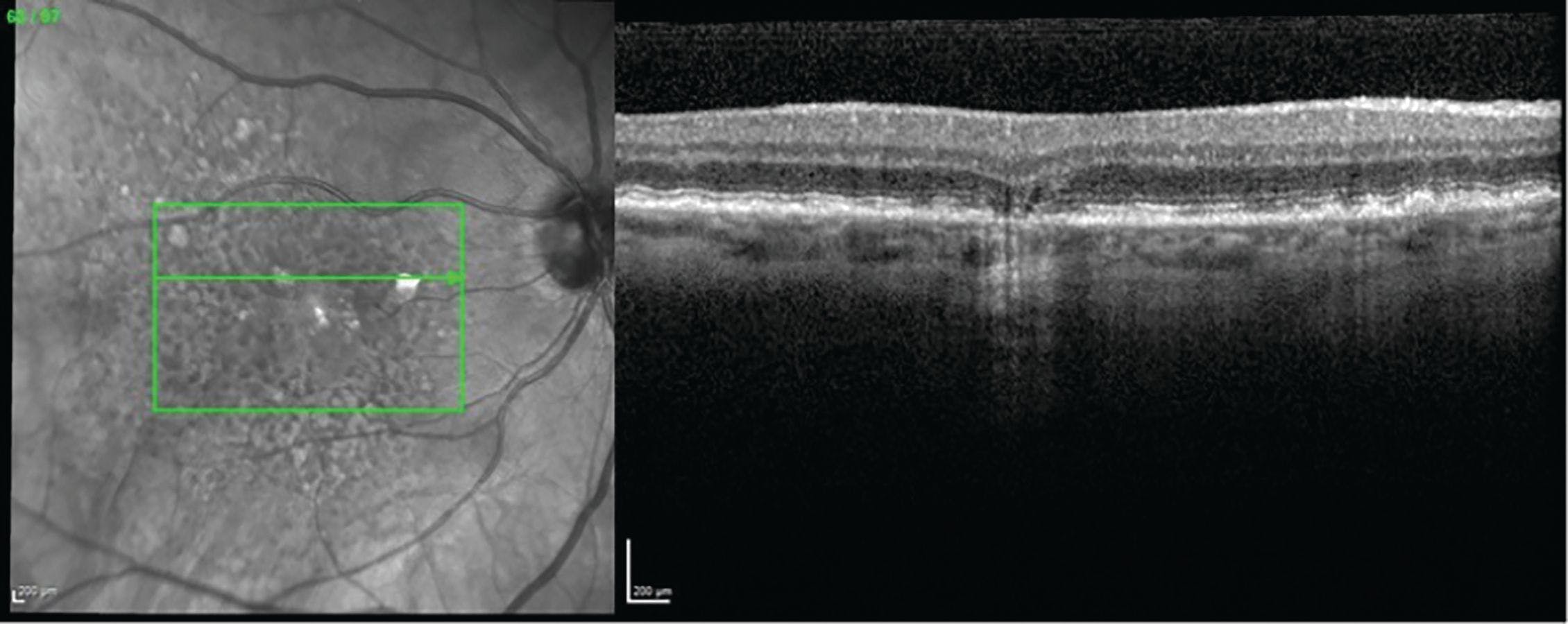 High-resolution multimodal imaging is key in dry AMD therapeutic development, future management
