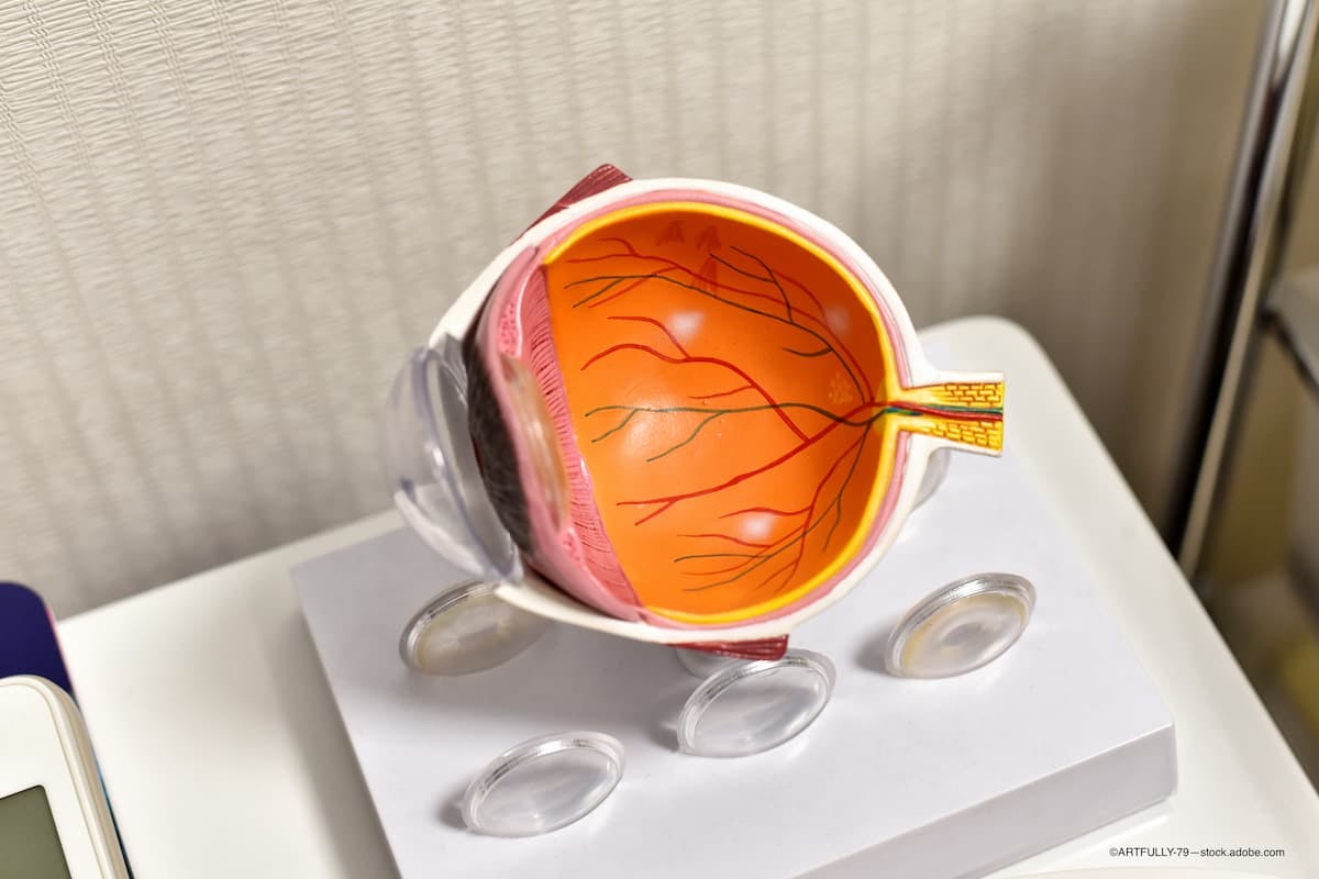 Suprachoroidal injection successfully delivers drug to the macula, posterior segment