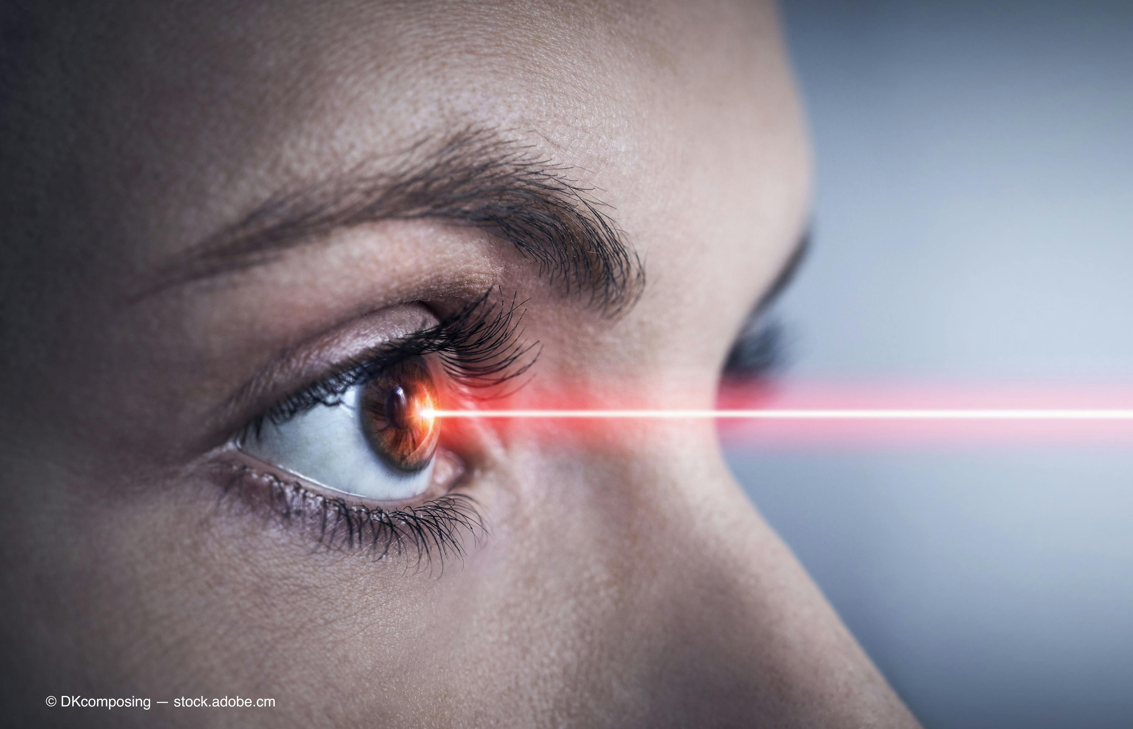 laser for diabetic macular edema