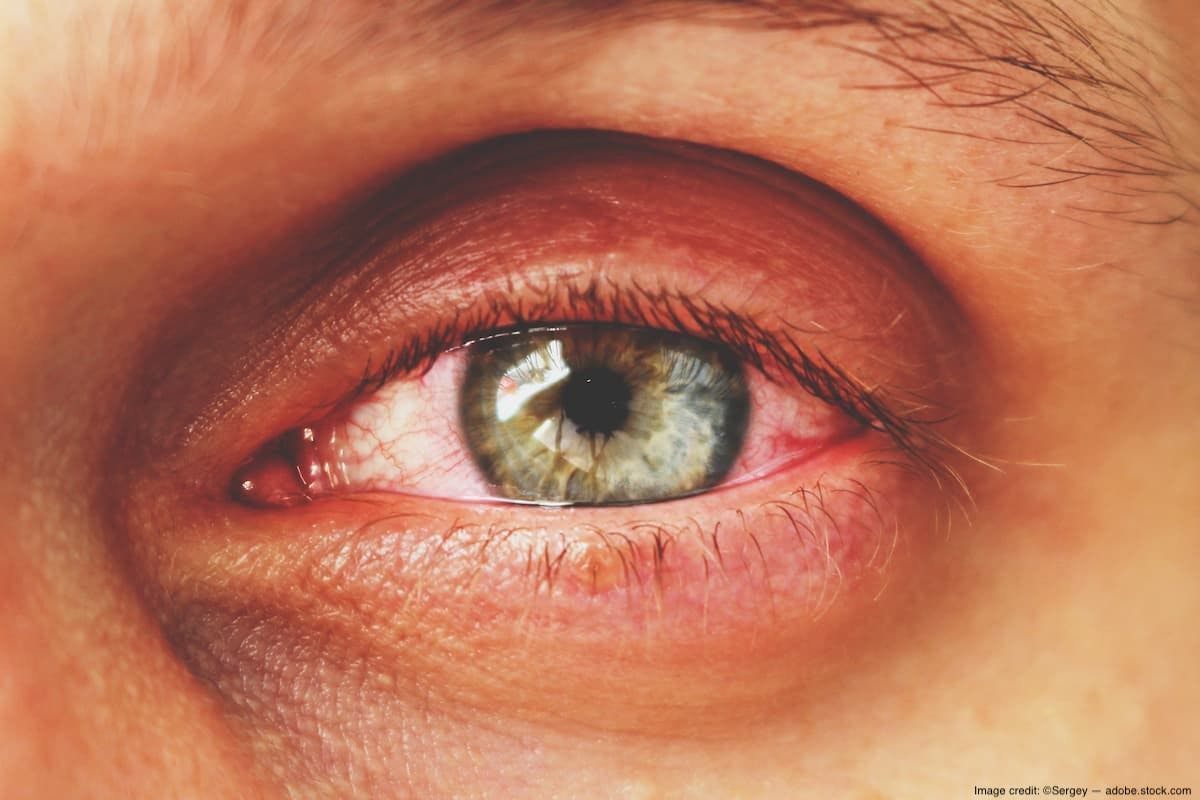 Considering small case series of acute intraocular inflammation post-faricimab injections