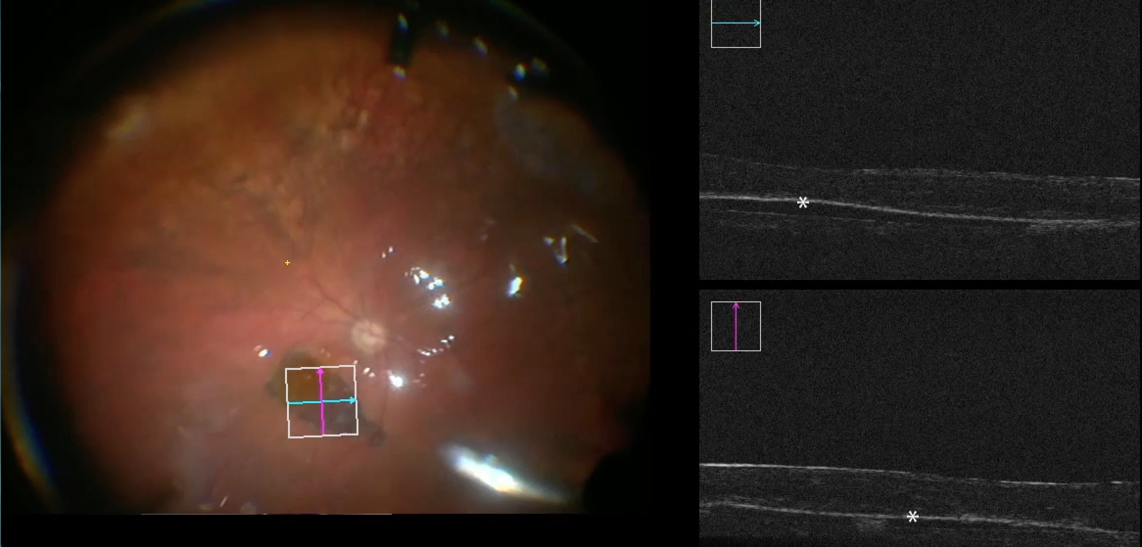 Intraoperative surgical methods hold key to AMD treatment