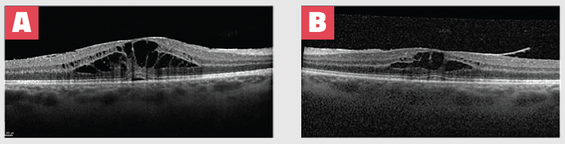 Figure 2. OCT imaging at presentation shows evidence of bilateral macular edema and ERM. Macular edema was more severe OD (A) than OS (B), which correlated with BCVA of 20/70 OD and 20/50 OS. 