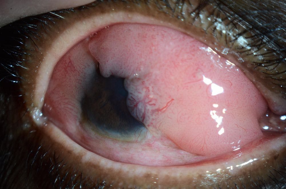 Investigators found that prevalence rates of ocular surface tumors differed across all geographic areas. (Image courtesy of Nathan Hall, MS, BS)