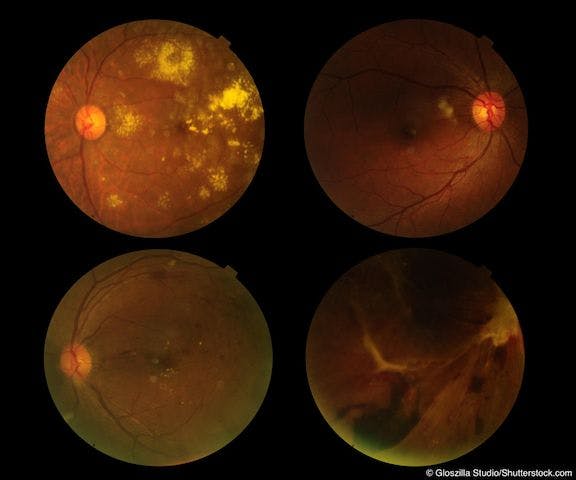 Anti-VEGF injections and glaucoma: Surgeons must watch IOP elevation 