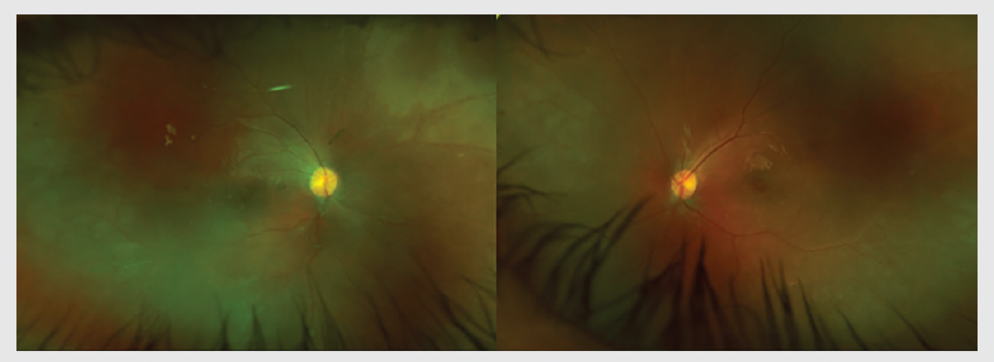 Wide-field fundus photographs (A, B) of a 12-year-old Vietnamese American boy with occlusive retinal vasculitis associated with Adamantiades-Behcet Disease showing pale optic nerve, sclerosis of superior nasal retinal arteries, vascular sheathing of temporal inferior arteries, and collateral vessels in the peripheral retina.