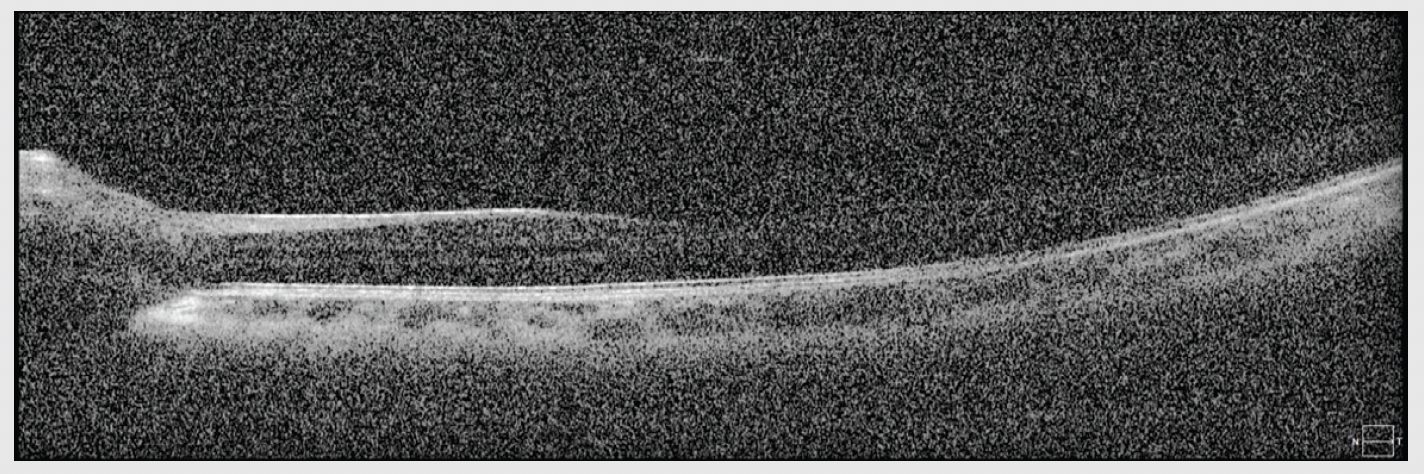Figure 4. OCT imaging from a patient with a uveitic flare up. The poor image quality can be attributed to opacification and haze of the vitreous. 