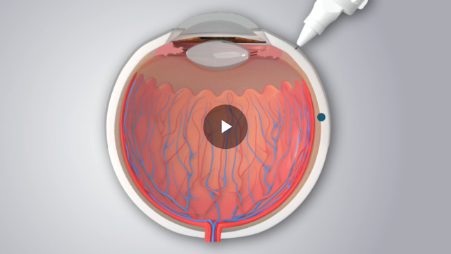 Acing the suprachoroidal injection for targeted drug delivery