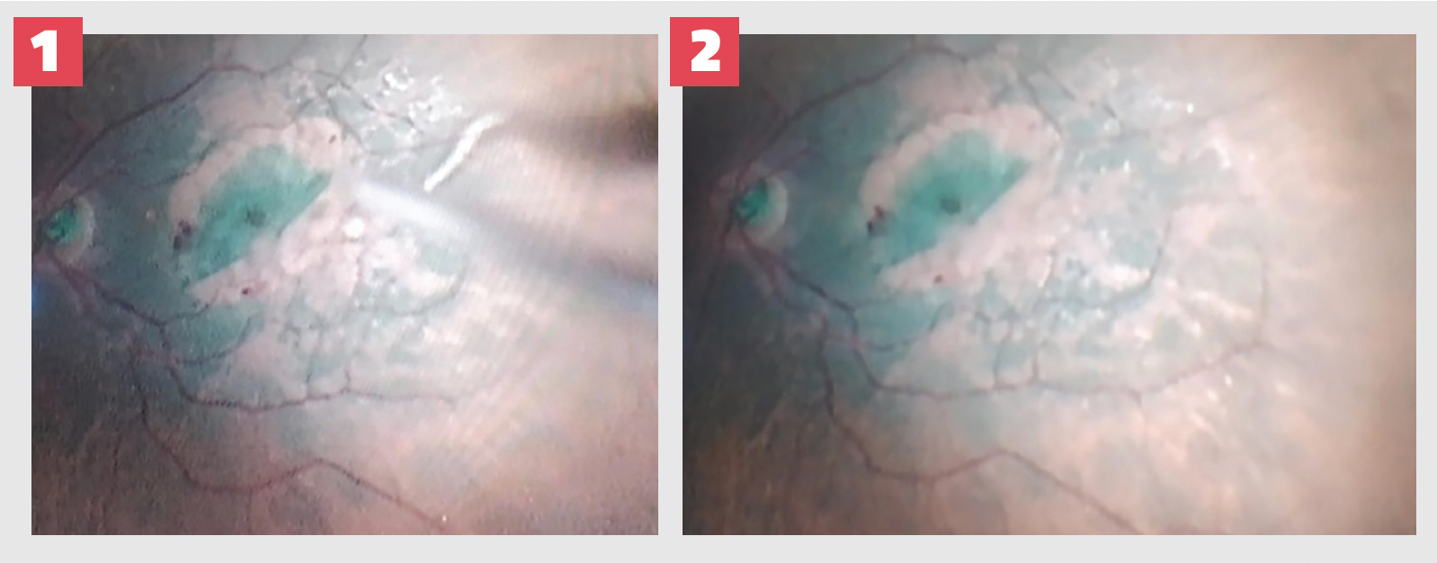 Figures 1 and 2. These intraoperative images show how to apply viscoelastic adhesive with a silicone-sleeve cannula over the internal limiting membrane used as flap.