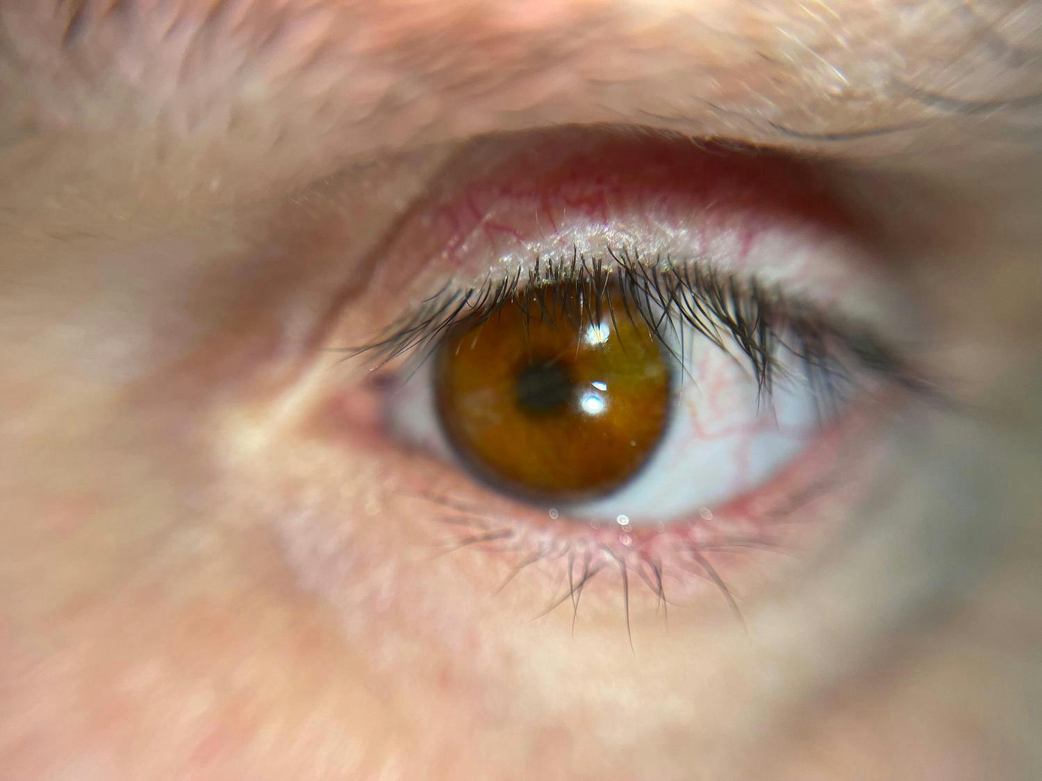 3D-printed prosthetic eye successfully created by Fraunhofer Institute