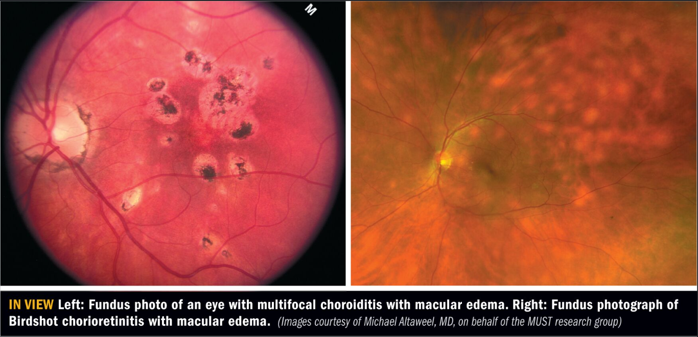 Managing uveitic macular edema