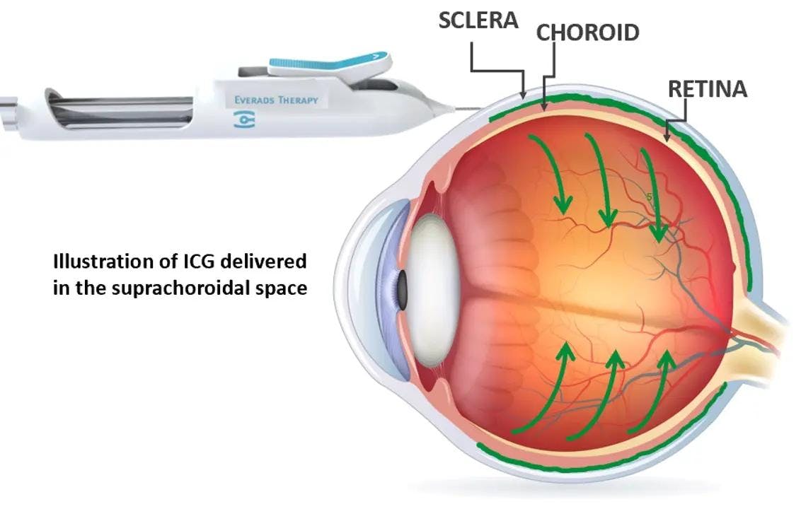 Illustration of ICG delivered in the suprachoroidal space