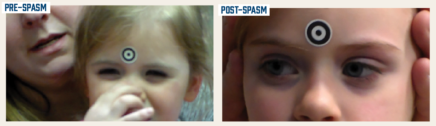 A young patient is shown before a spasm and after an achromatopsia episode. (Images courtesy of Richard W. Hertle, MD)