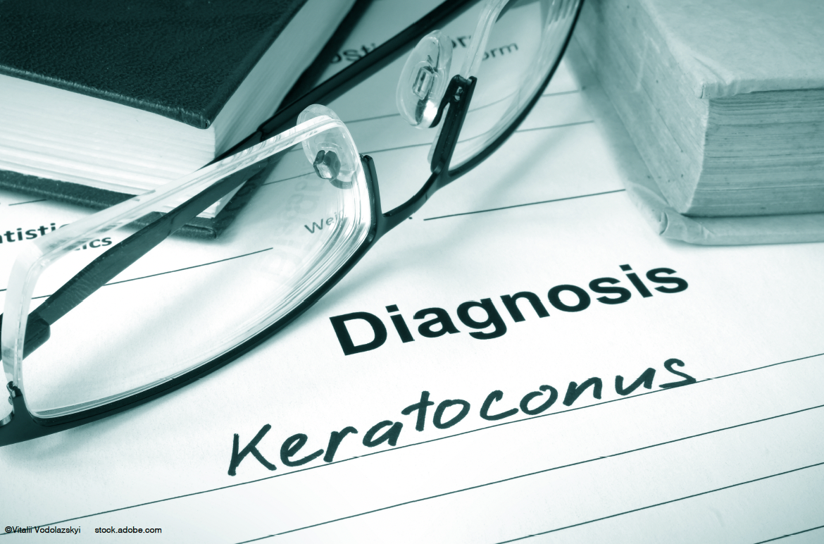 Testing a theory for children with keratoconus