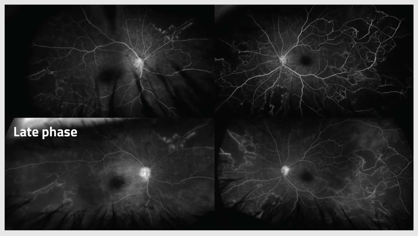 Corresponding early and late wide-angle fluorescein angiography of the right and left eyes showing optic disc and peri-vascular leakage and widespread retinal ischemia.