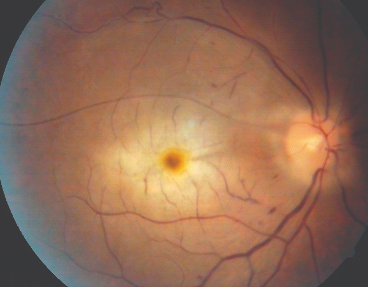 Timely recognition of central retinal arterial occlusions key for patients