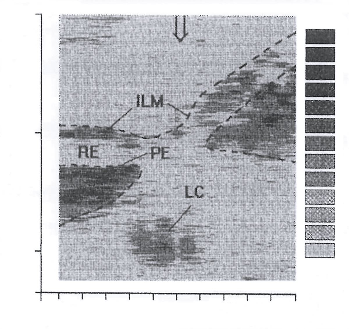 In vivo retinal image recorded by Fercher’s group.1,2 ILM, inner limiting membrane; LC, lamina cribrosa; PE, pigment epithelium; RE, retina.