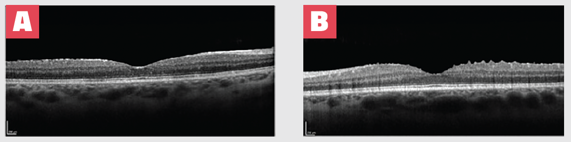 Figure 3. OCT imaging at 6 months following Yutiq administration revealed resolution of macular edema OD (A) and OS (B). BCVA was measured as 20/25 OD and 20/20 OS.