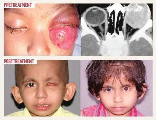 Ophthalmologists are learning to treat orbital retinoblastoma with a combination approach. (Images courtesy of Fairooz Puthiyapurayil-Manjandavida, MD)