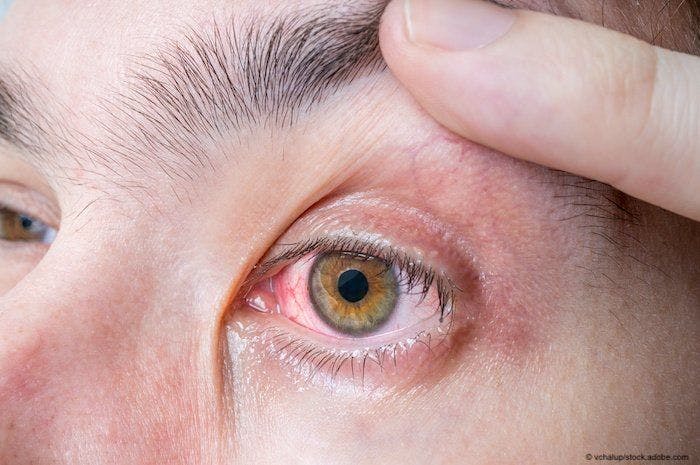 IL-6 inhibition shows promise as treatment for non-infectious uveitis