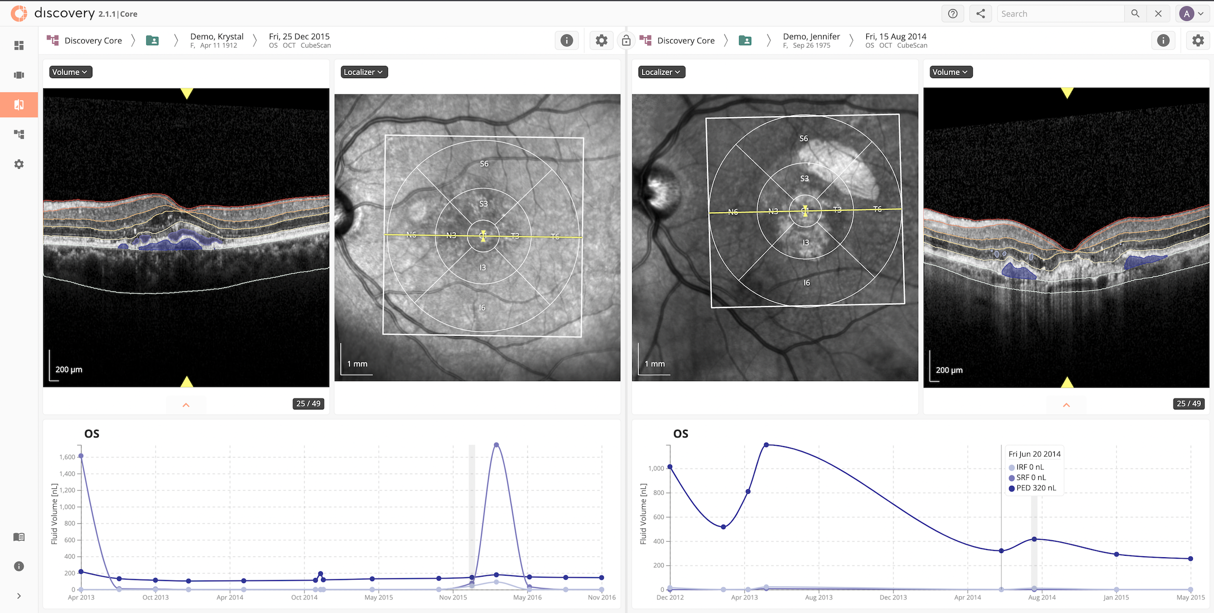 A look at the Discovery CORE platform and its AI. Features displayed include the overlay of AI on OCT images to visualize fluid and layers, side-by-side imaging comparisons on two different time-points or visits, and at the bottom, progression plots for retinal fluid volume of a patient over time. (Image courtesy of RetinAI)