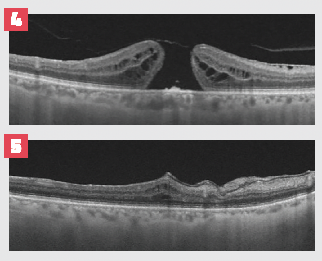 Figures 4 and 5. Optical coherence tomography shows the macular hole (Figure 4) and its closure (Figure 5) 2 months after surgery. In this case, the anterior lens capsule was used as flap.