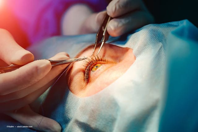 APAO 2023: Beveled tip probe added to arsenal for retinal detachment vitrectomy