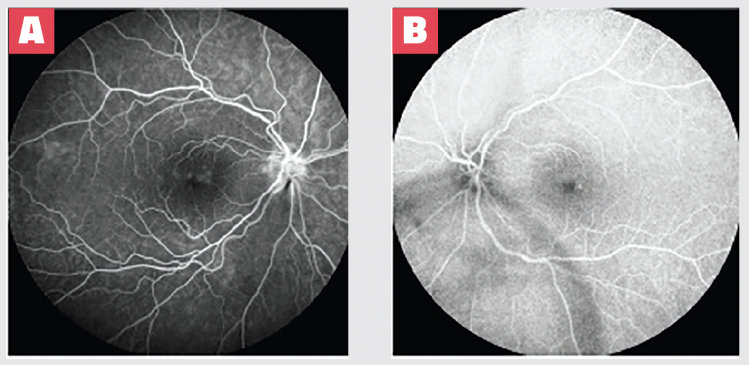 Figure 1. Fluorescein angiography OD (A) and OS (B) at presentation depicted optic nerve head capillary leakage in the right eye and petaloid macular leakage bilaterally. These nonspecific findings are consistent with a diagnosis of pars planitis, given the unrevealing diagnostic work-up and presence of inflammatory cells within the vitreous cavity.