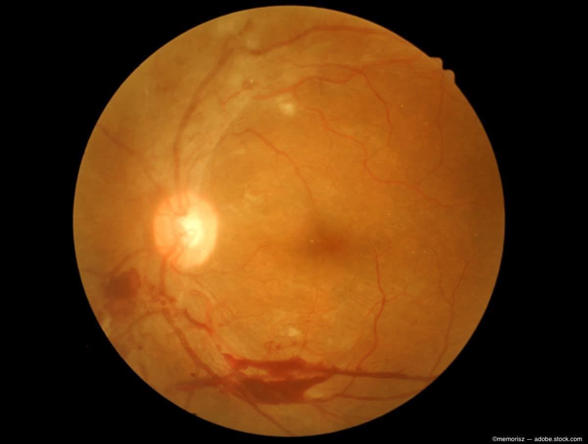 retina image with diabetic retinopathy Image credit: AdobeStock/memorisz