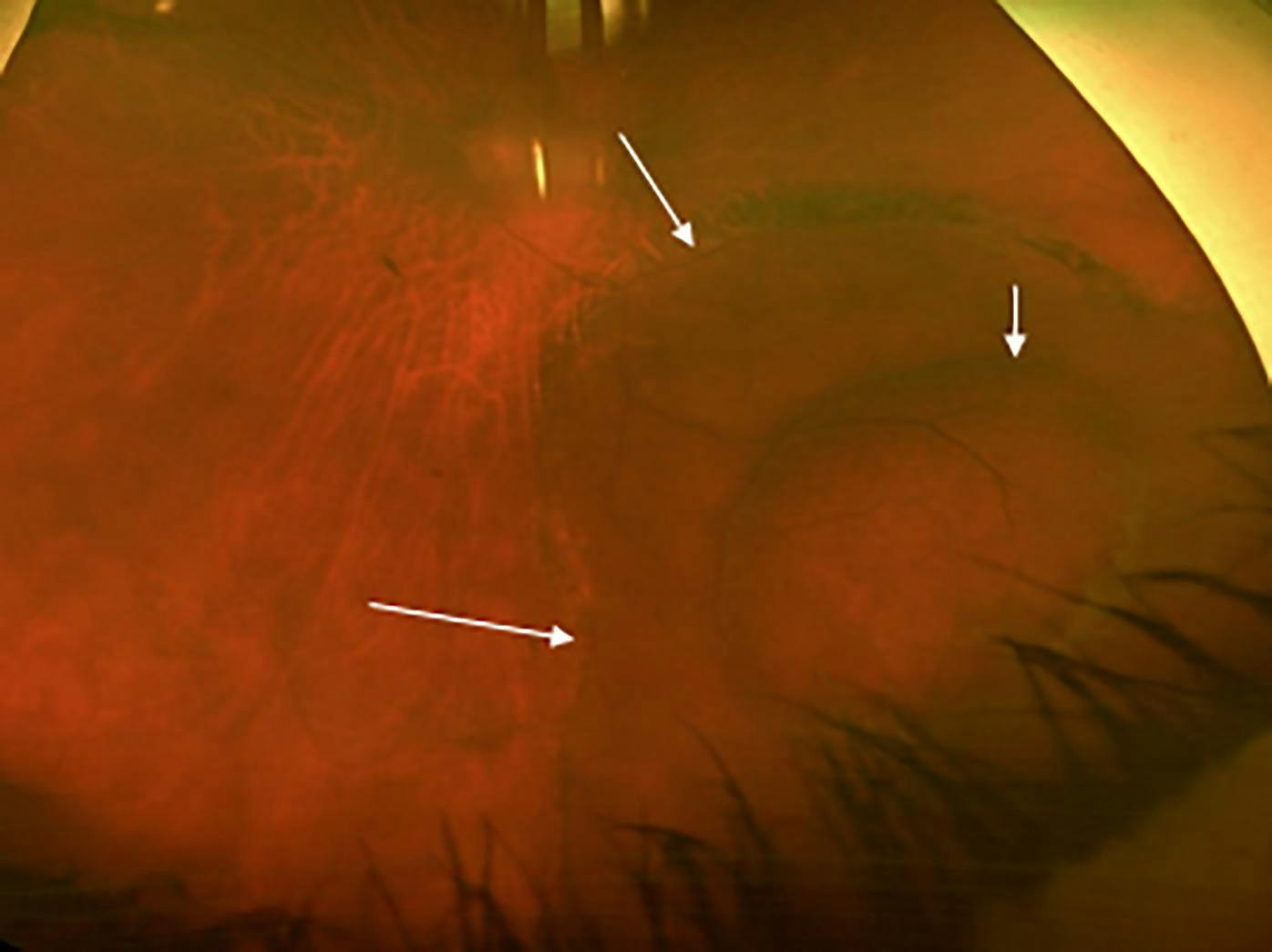 Wide-field color photograph of progressive symptomatic retinal detachment complicating degenerative retinoschisis. The white arrow to the right depicts the limit of the degenerative retinoschisis, the 2 white arrows to the left depict the limit of the progressive symptomatic retinal detachment.