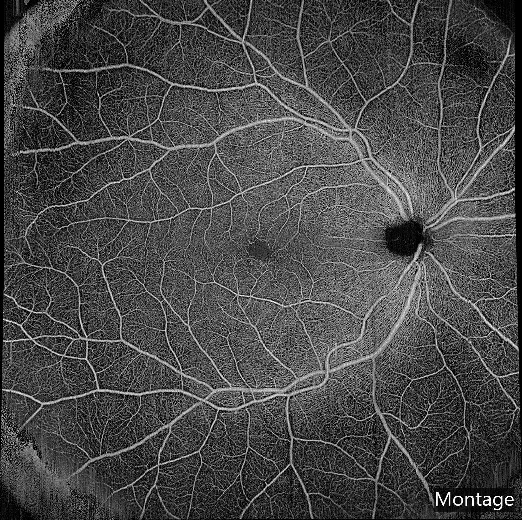 (Figure 1) Montage from 2 15- ×15-mm OCTA images (PlexElite, Carl Zeiss Meditec) of the fundus of a diabetic patient. An example of the high level of information that can be acquired today in a short time during follow-up of a diabetic patient that needs an exceedingly long time of analysis unless helped and improved with algorithms under development by EviRed. (Image courtesy of Ramin Tadayoni, MD, PhD)