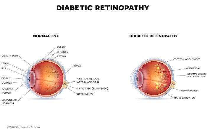 Guidelines for treating the diabetic eye patient