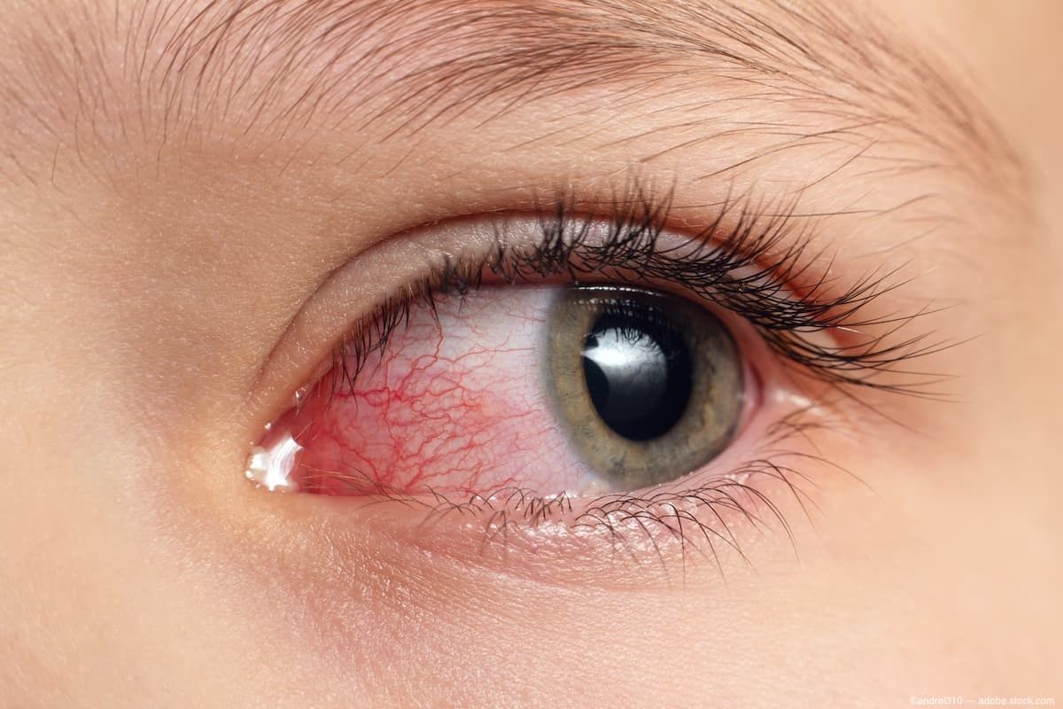 Eye with irritation (Image credit: AdobeStock/andrei310)
