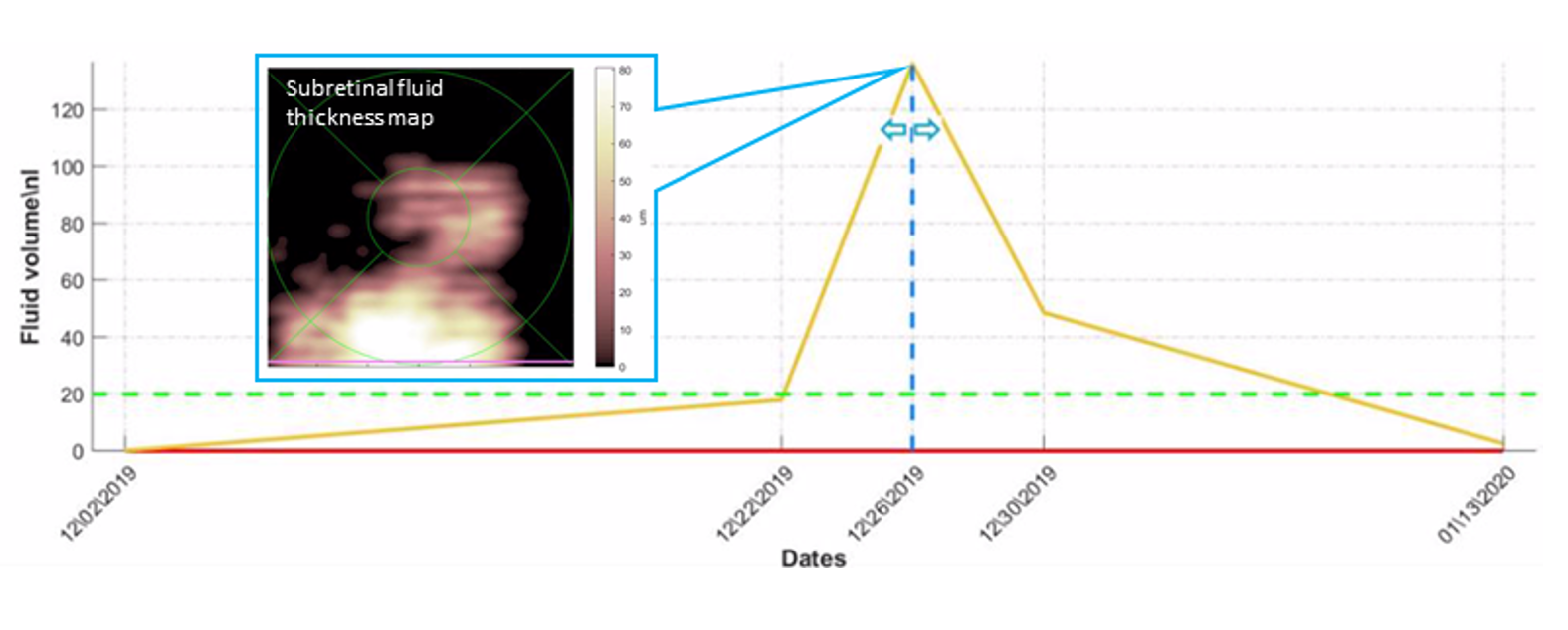 Figure 2: AI-based fluid quantification, mapping and tracking over time in a patient under anti-VEGF therapy (A. Loewenstein, Tel Aviv Medical Center, Tel Aviv, Israel)