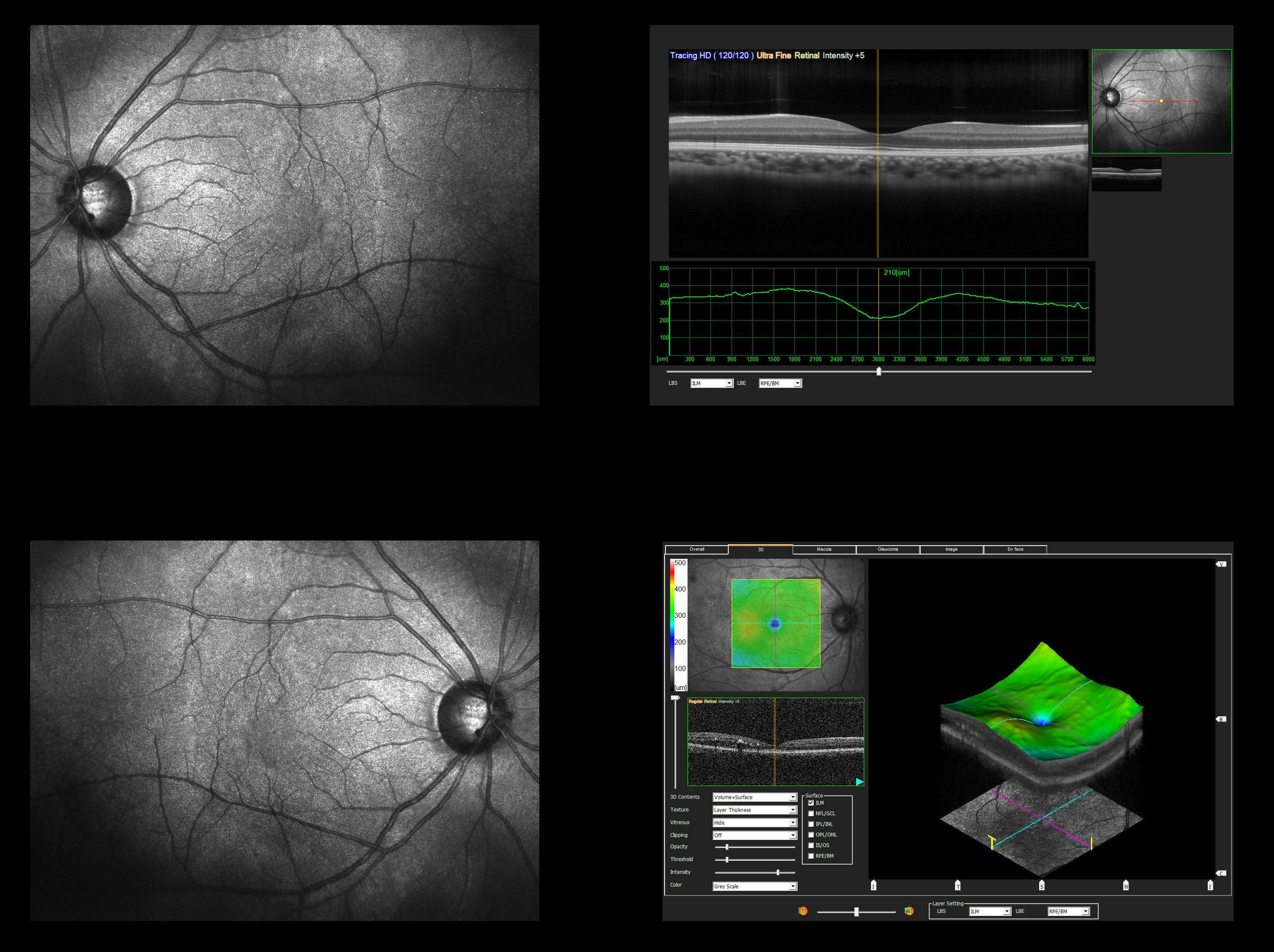 retina layer changes in AMD