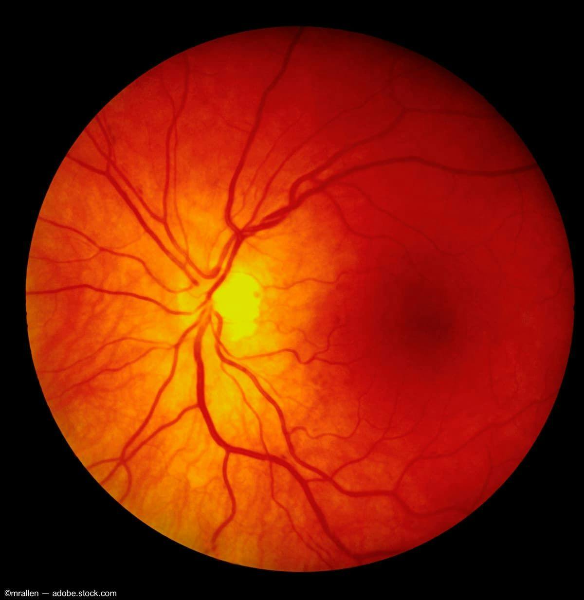 Structural and vascular changes detected in RVO affected eyes and unaffected fellow eyes 