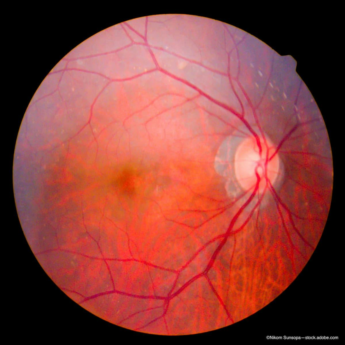 Unraveling burdens of X-linked retinitis pigmentosa
