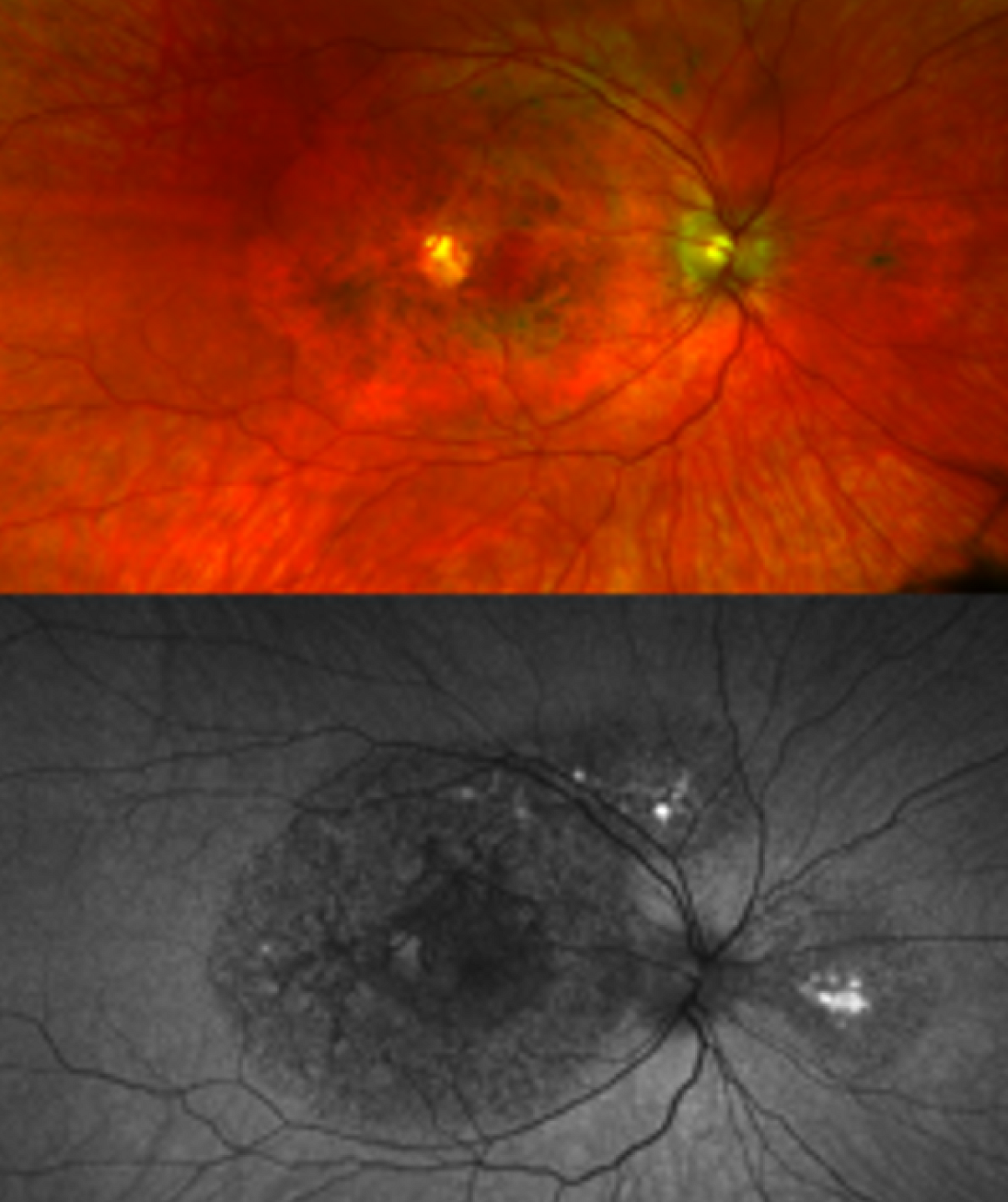 New genetic eye disease discovered by NIH researchers