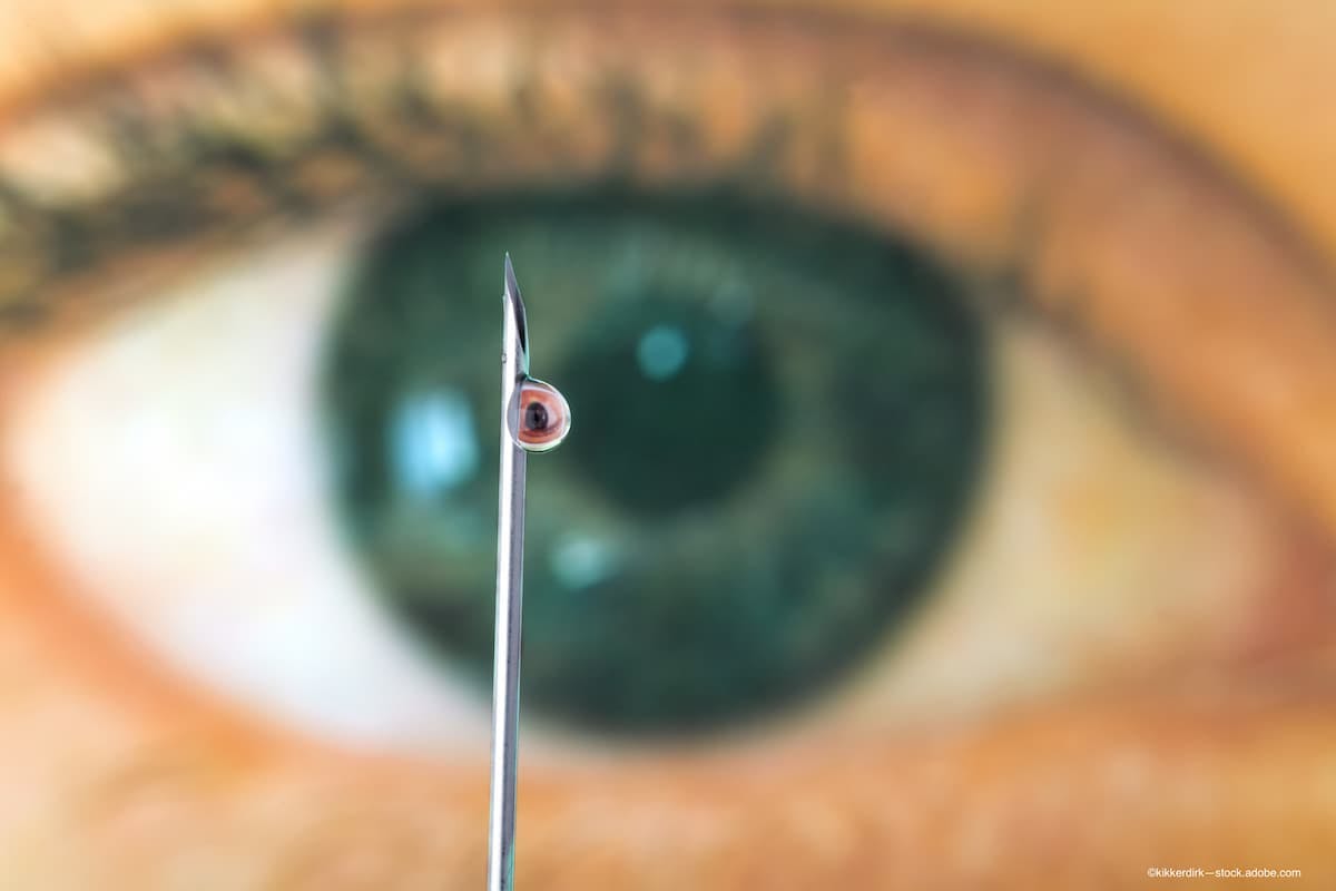 From intravitreal injections to gene therapy, new AMD treatments are on the horizon