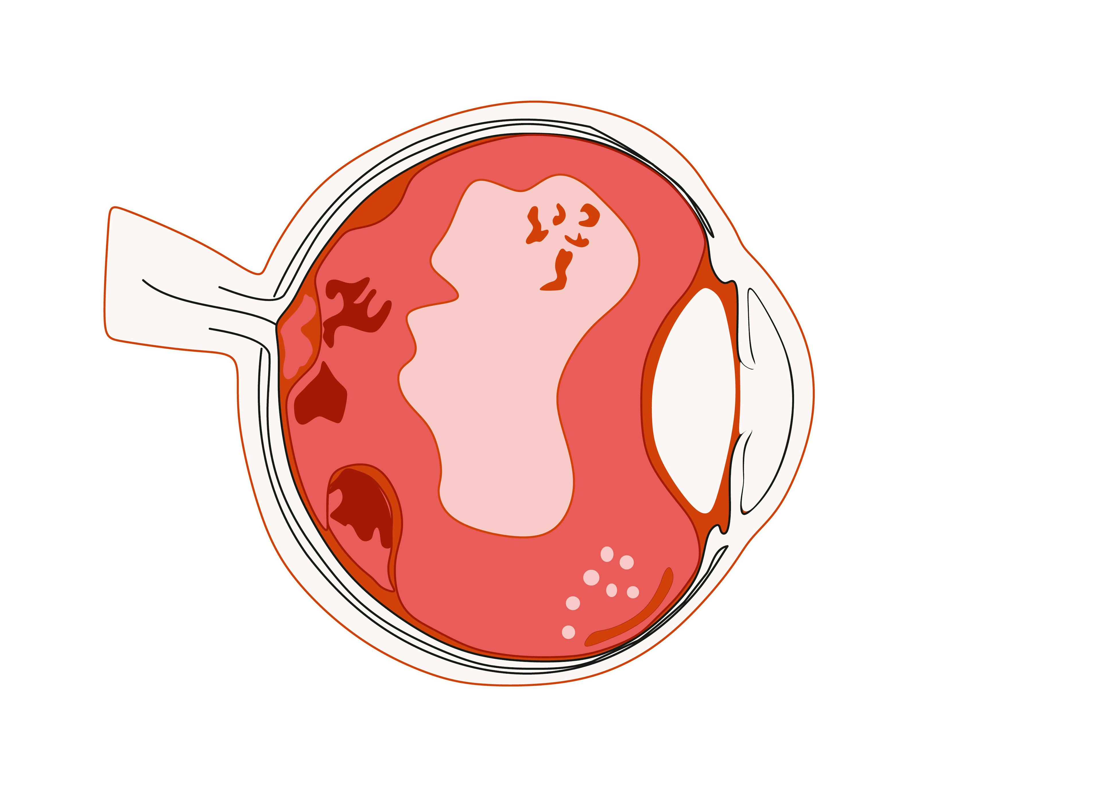 In-home self-monitoring of AMD patients identifies retinal fluid 