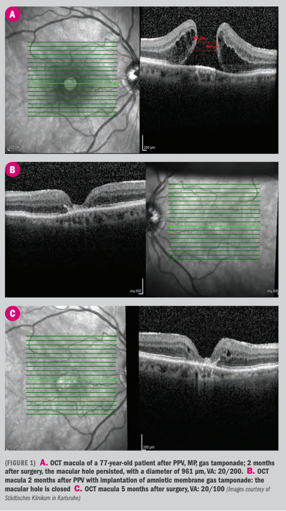 (FIGURE 1) A. OCT macula of a 77-year-old patient after PPV, MP, gas tamponade; 2 months after surgery, the macular hole persisted, with a diameter of 961 µm, VA: 20/200. B. OCT macula 2 months after PPV with implantation of amniotic membrane gas tamponade: the macular hole is closed C. OCT macula 5 months after surgery, VA: 20/100.